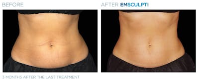 Emsculpt Neo Before & After Gallery - Patient 160932259 - Image 1