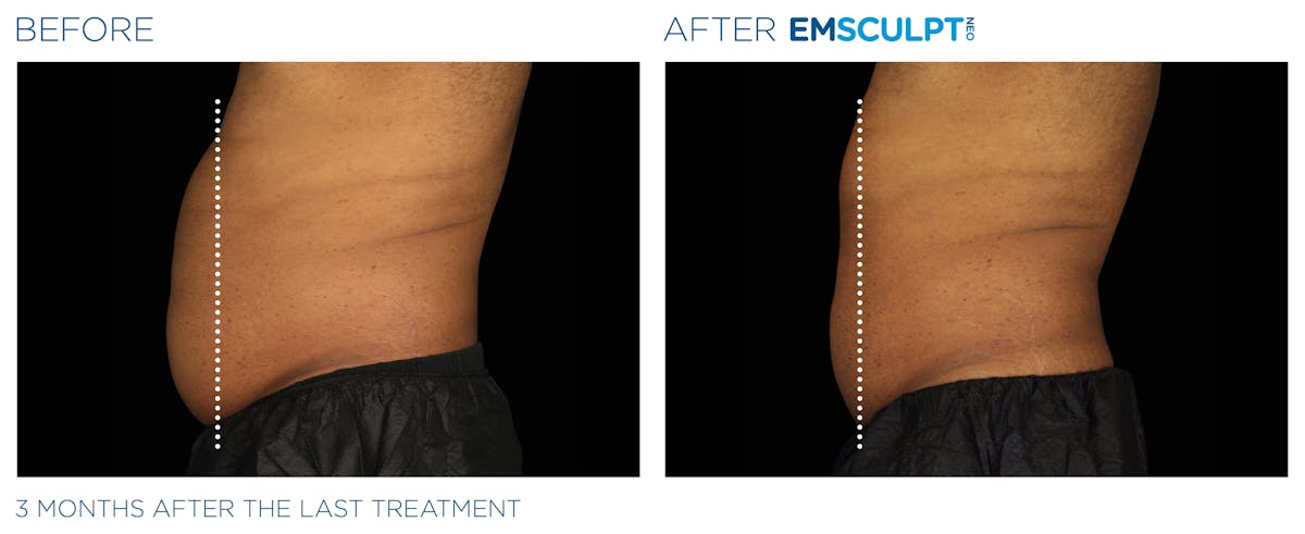 Emsculpt Neo Before & After Gallery - Patient 160932260 - Image 1