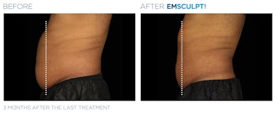 Emsculpt Neo Before & After Gallery - Patient 160932260 - Image 1