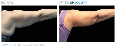 Emsculpt Neo Before & After Gallery - Patient 160932261 - Image 1