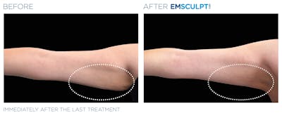 Emsculpt Neo Before & After Gallery - Patient 160932262 - Image 1