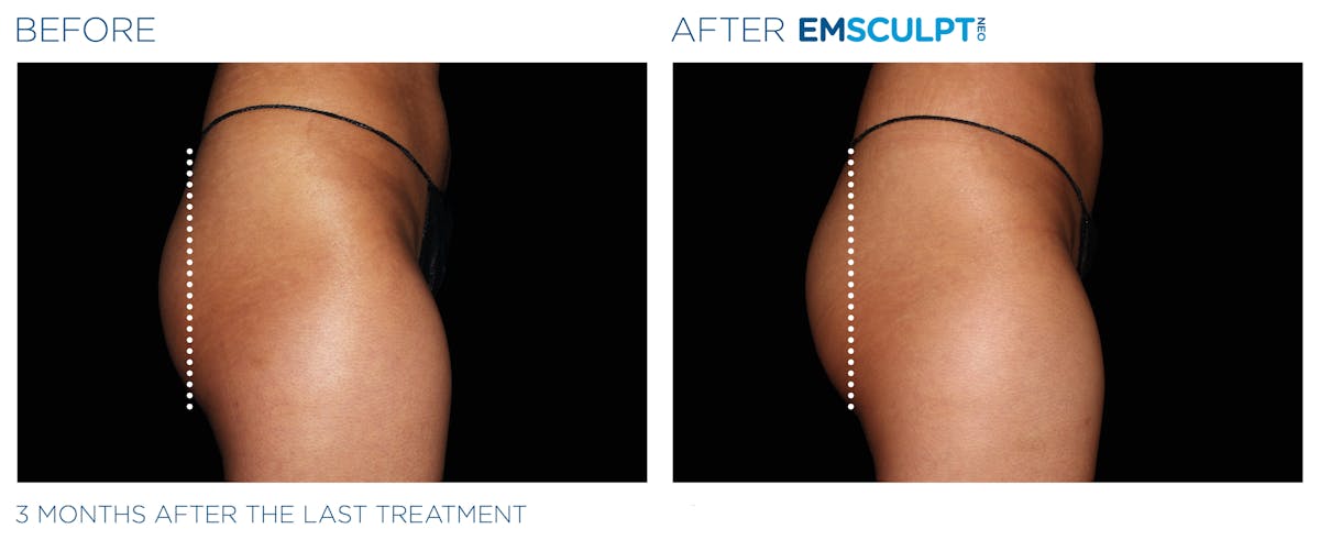 Emsculpt Neo Before & After Gallery - Patient 160932263 - Image 1