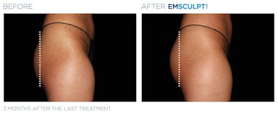 Emsculpt Neo Before & After Gallery - Patient 160932263 - Image 1