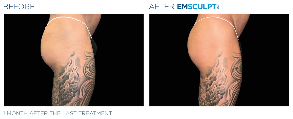 Emsculpt Neo Before & After Gallery - Patient 160932264 - Image 1