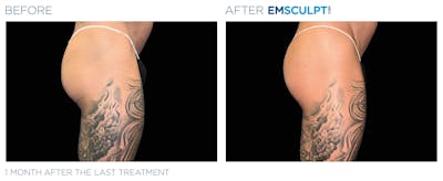 Emsculpt Neo Before & After Gallery - Patient 160932264 - Image 1