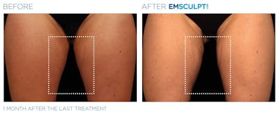 Emsculpt Neo Before & After Gallery - Patient 160932265 - Image 1