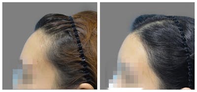 Hair Transplant Before & After Gallery - Patient 160933711 - Image 1