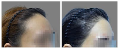 Hair Transplant Before & After Gallery - Patient 160933712 - Image 1