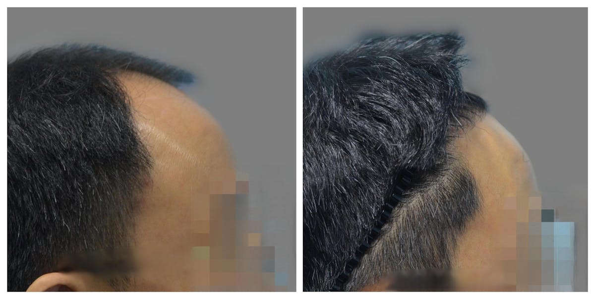 Hair Transplant Before & After Gallery - Patient 160933713 - Image 1