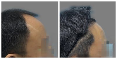Hair Transplant Before & After Gallery - Patient 160933713 - Image 1