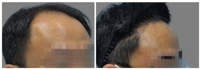 Hair Transplant Before & After Gallery - Patient 160933714 - Image 1