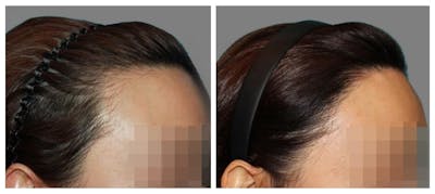 Hair Transplant Before & After Gallery - Patient 160933715 - Image 1