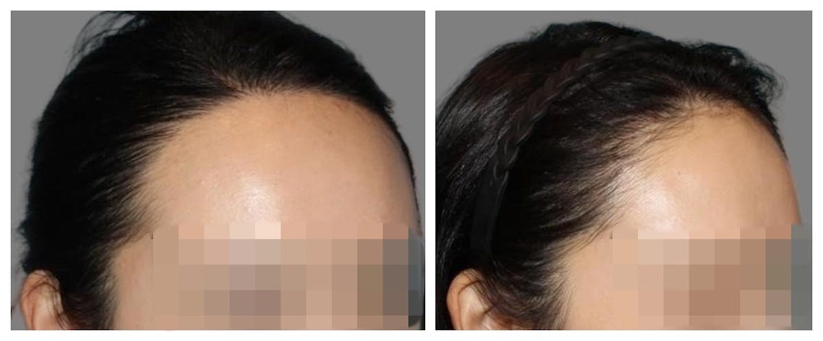Hair Transplant Before & After Gallery - Patient 160933716 - Image 1