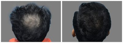 Hair Transplant Before & After Gallery - Patient 160933717 - Image 1
