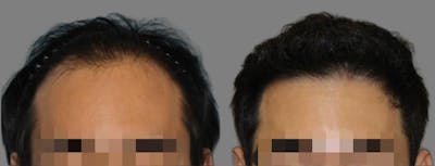 Hair Transplant Before & After Gallery - Patient 160933718 - Image 1