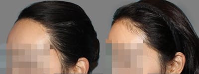 Hair Transplant Before & After Gallery - Patient 160933719 - Image 1