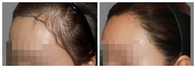 Hair Transplant Before & After Gallery - Patient 160933720 - Image 1