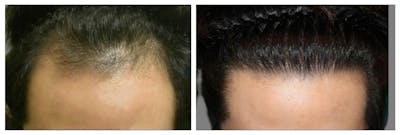 Hair Transplant Before & After Gallery - Patient 160933721 - Image 1