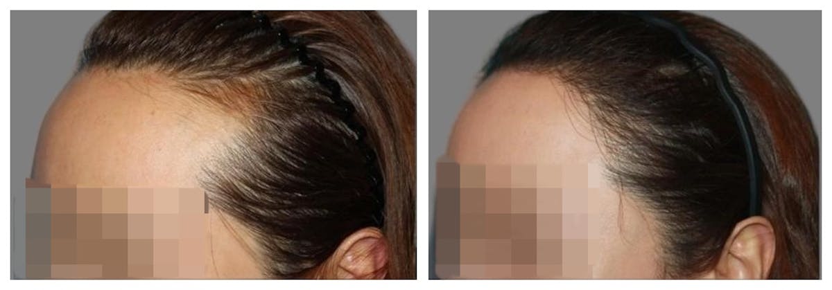Hair Transplant Before & After Gallery - Patient 160933722 - Image 1