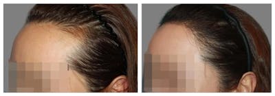 Hair Transplant Before & After Gallery - Patient 160933722 - Image 1