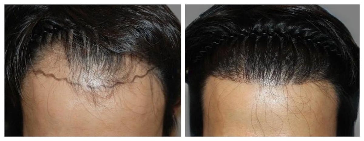 Hair Transplant Before & After Gallery - Patient 160933723 - Image 1