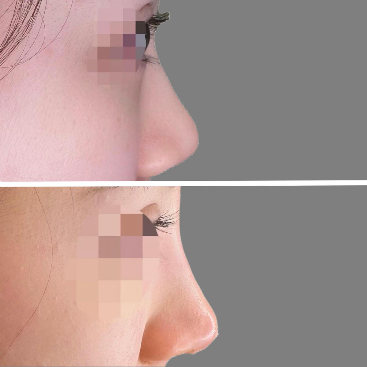 Non Surgical Before & After Gallery - Patient 160939056 - Image 1