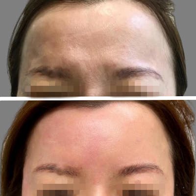 Non Surgical Before & After Gallery - Patient 160939052 - Image 1
