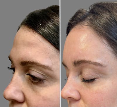 Non Surgical Before & After Gallery - Patient 160939054 - Image 1
