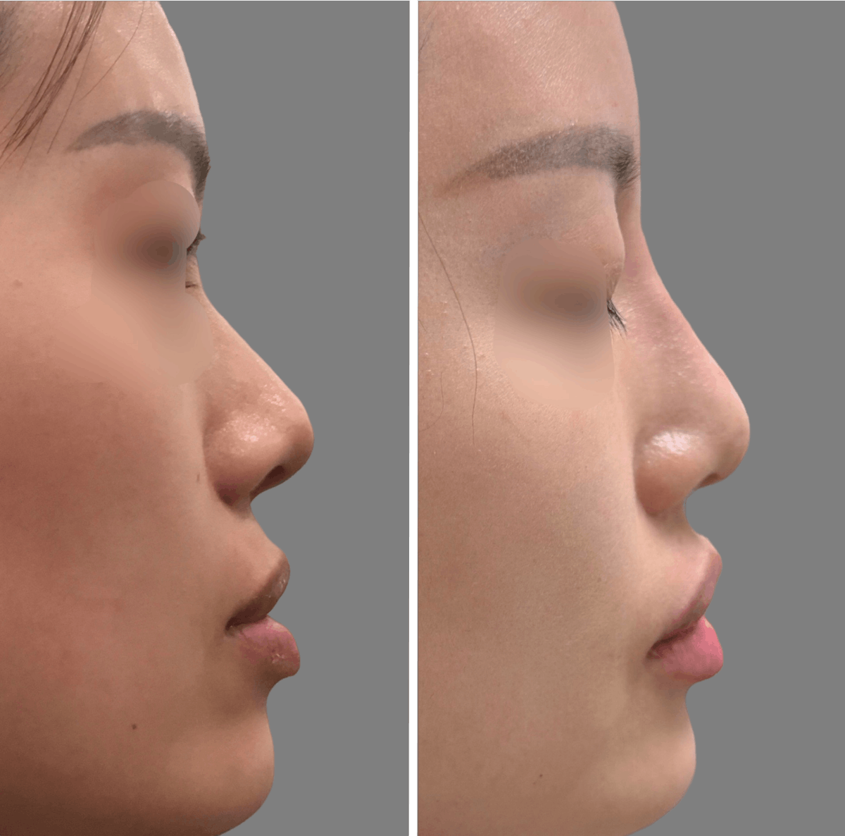 Non Surgical Before & After Gallery - Patient 160939058 - Image 1