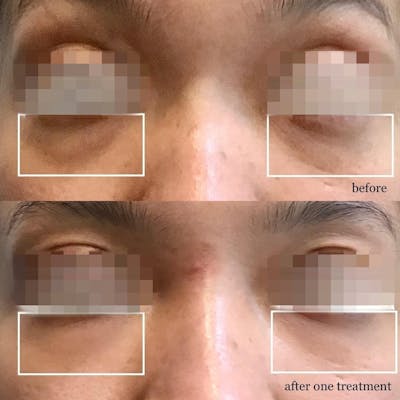 Non Surgical Before & After Gallery - Patient 160939059 - Image 1