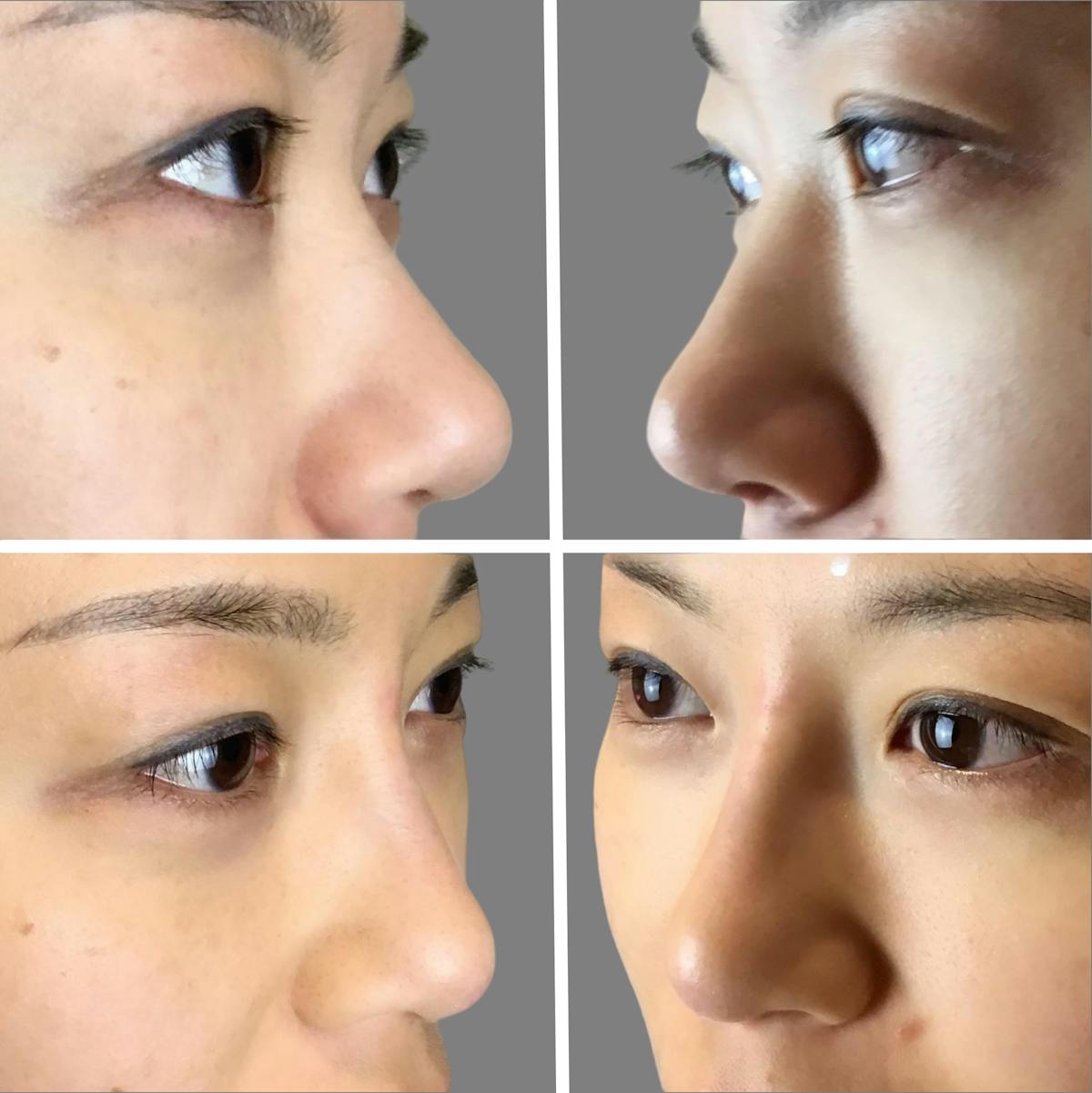 Non Surgical Before & After Gallery - Patient 160939060 - Image 1