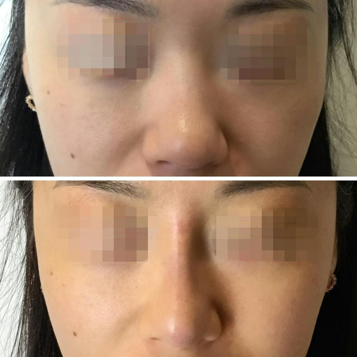 Non Surgical Before & After Gallery - Patient 160939061 - Image 1