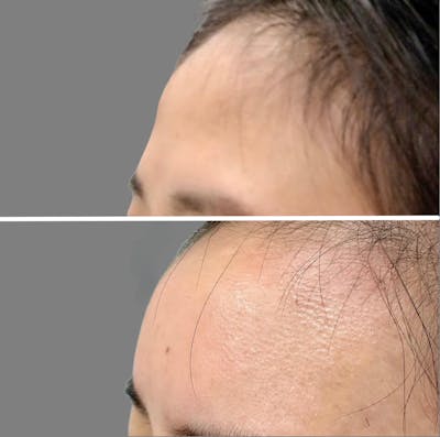 Non Surgical Before & After Gallery - Patient 160939053 - Image 1