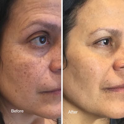 Non Surgical Before & After Gallery - Patient 160939055 - Image 1