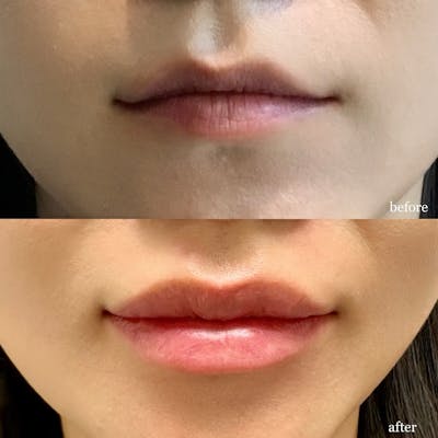 Non Surgical Before & After Gallery - Patient 160939064 - Image 1