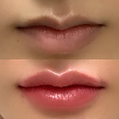 Non Surgical Before & After Gallery - Patient 160939065 - Image 1