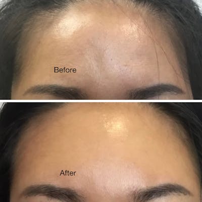 Non Surgical Before & After Gallery - Patient 160939051 - Image 1