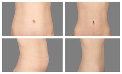 Liposuction Before & After Gallery - Patient 194036 - Image 1