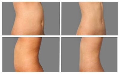 Liposuction Before & After Gallery - Patient 360218 - Image 1