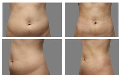 Liposuction Before & After Gallery - Patient 197171 - Image 1