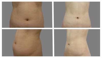 Liposuction Before & After Gallery - Patient 189029 - Image 1