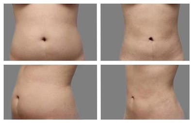 Liposuction Before & After Gallery - Patient 983265 - Image 1