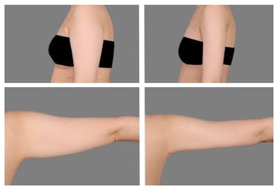 Liposuction Before & After Gallery - Patient 401774 - Image 1