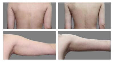 Liposuction Before & After Gallery - Patient 132216 - Image 1