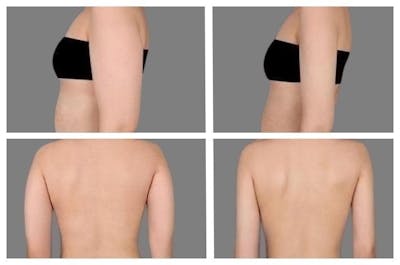 Liposuction Before & After Gallery - Patient 675544 - Image 1
