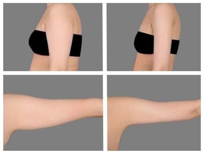 Liposuction Before & After Gallery - Patient 421830 - Image 1