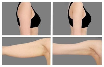 Liposuction Before & After Gallery - Patient 175941 - Image 1
