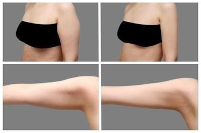 Liposuction Before & After Gallery - Patient 155952 - Image 1