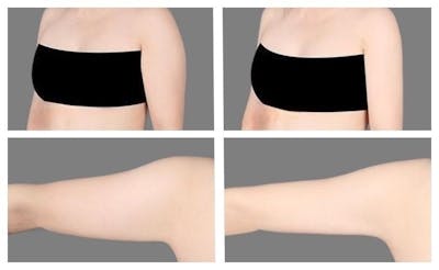 Liposuction Before & After Gallery - Patient 415176 - Image 1