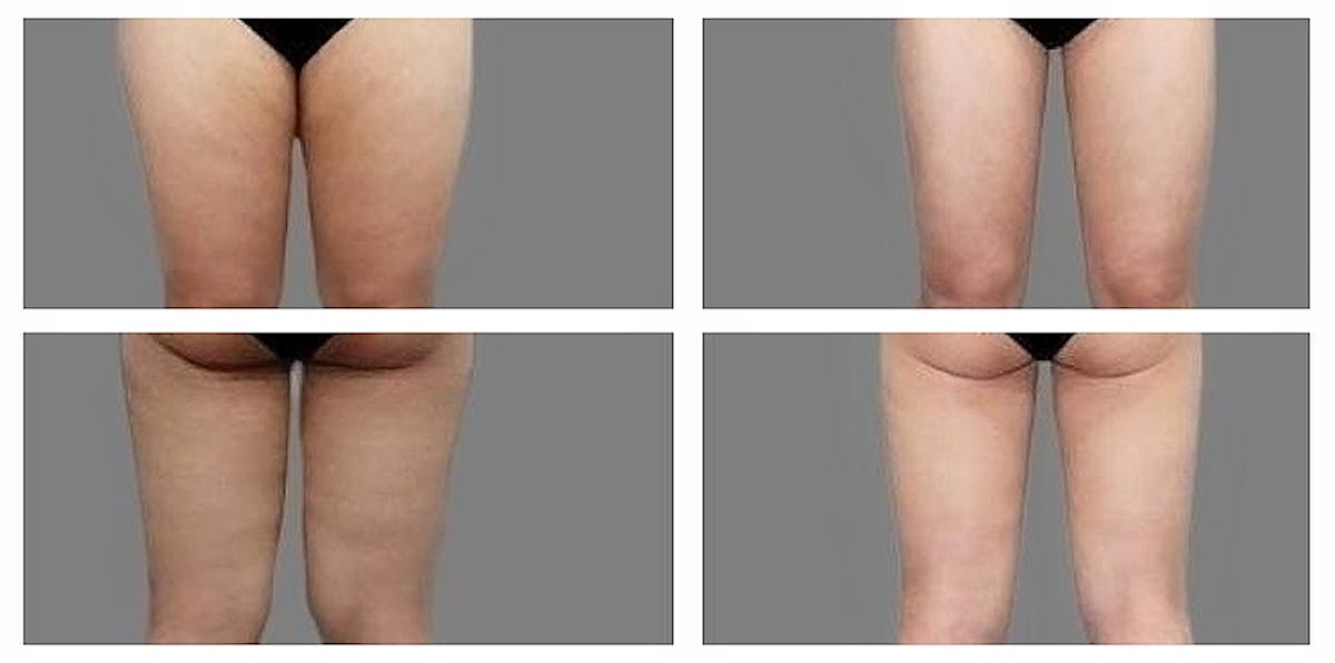 Liposuction Before & After Gallery - Patient 237676 - Image 1